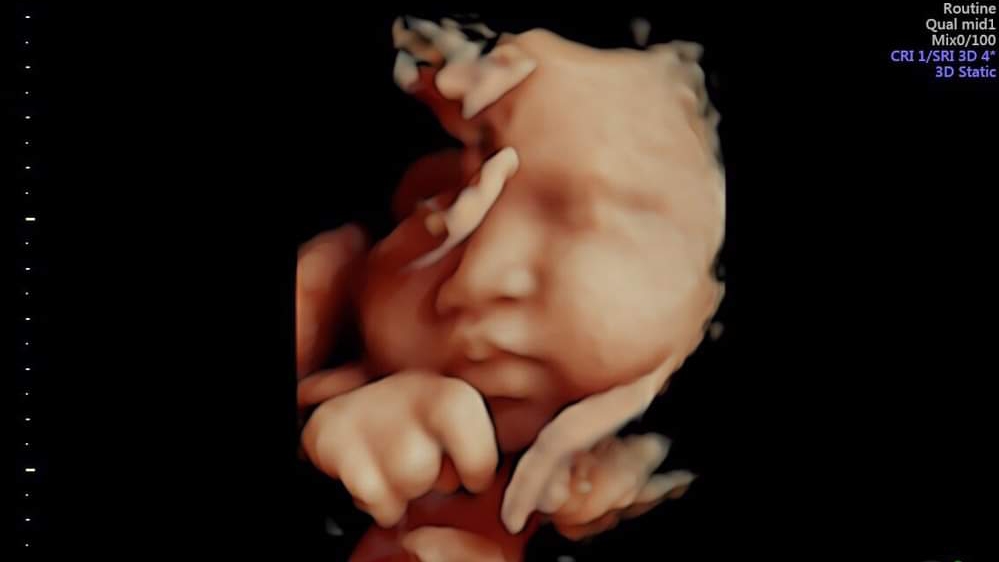 Siêu âm thai 5D – Sàng lọc dị tật – Xét nghiệm NIPT – Bs Giáp Hoàng Anh – Bắc Giang